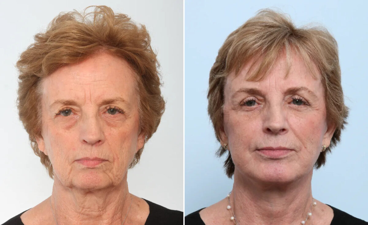 Eyelid Surgery / Blepharoplasty Before and After Photos in Houston, TX, Patient 26649