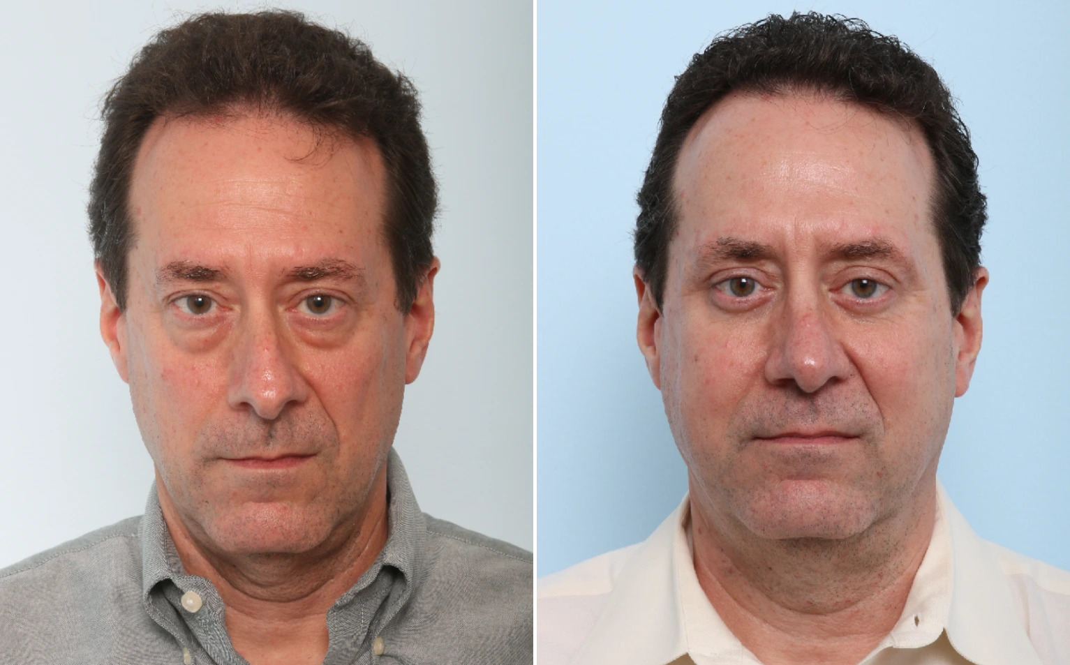Eyelid Surgery / Blepharoplasty Before and After Photos in Houston, TX, Patient 26658