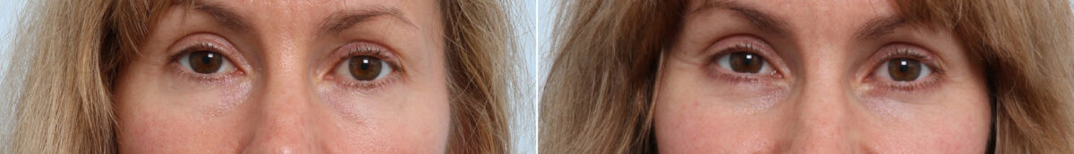 Eyelid Surgery / Blepharoplasty Before and After Photos in Houston, TX, Patient 26664