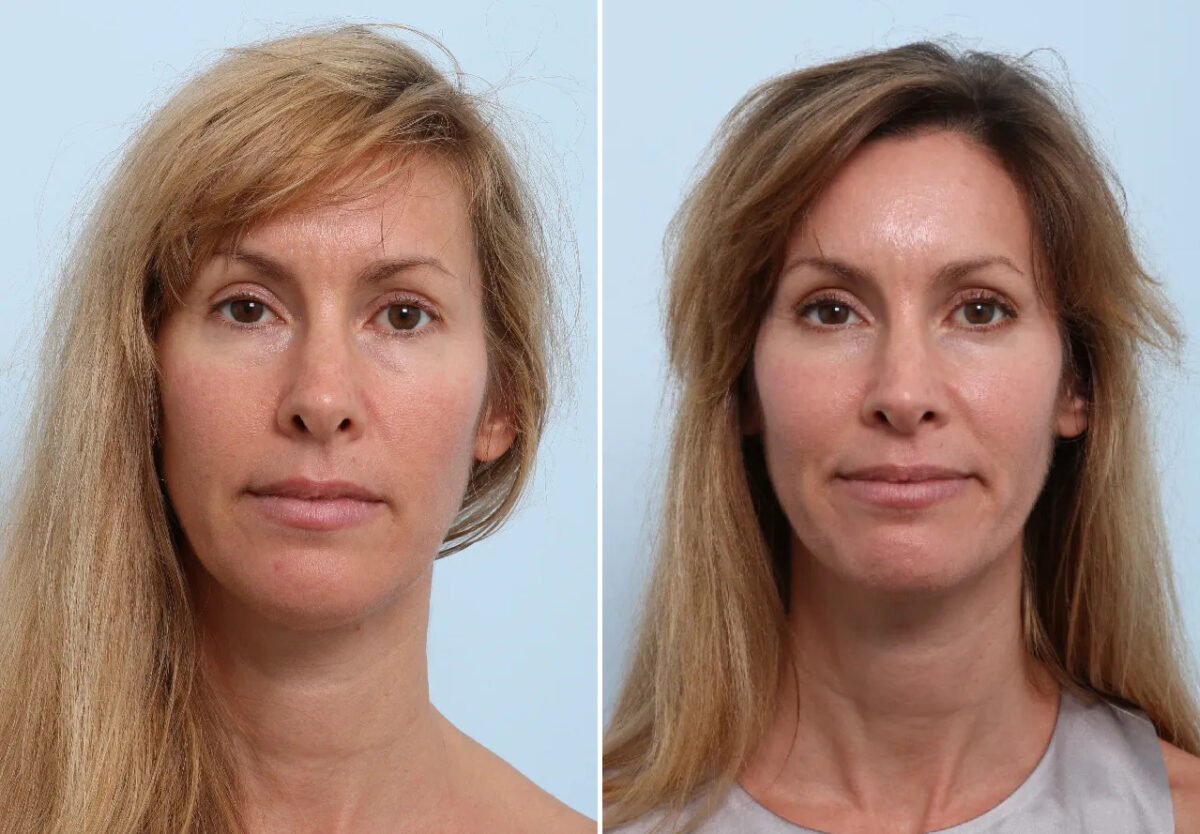 Patient 26664, Eyelid Surgery / Blepharoplasty Before and After Photos Eyelid Surgery / Blepharoplasty Before and After Photos in Houston, TX, Patient 26664