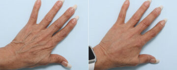 Fillers Before and After Photos in Houston, TX, Patient 60147