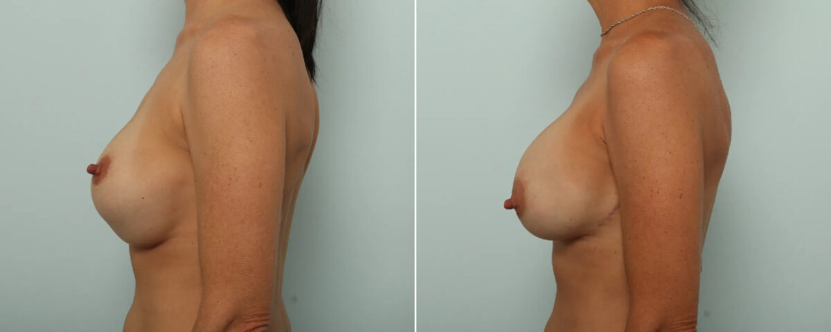 Breast Implant Exchange Before and After Photos in Houston, TX, Patient 87468