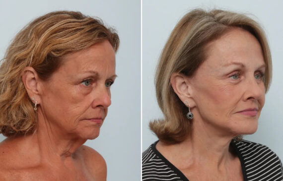 Facelift Before and After Photos in Houston, TX, Patient 87480