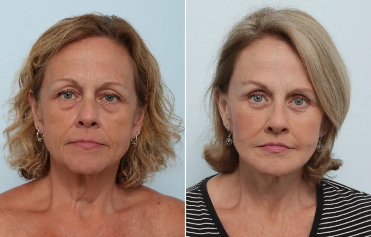 Facelift Before and After Photos in Houston, TX, Patient 87480