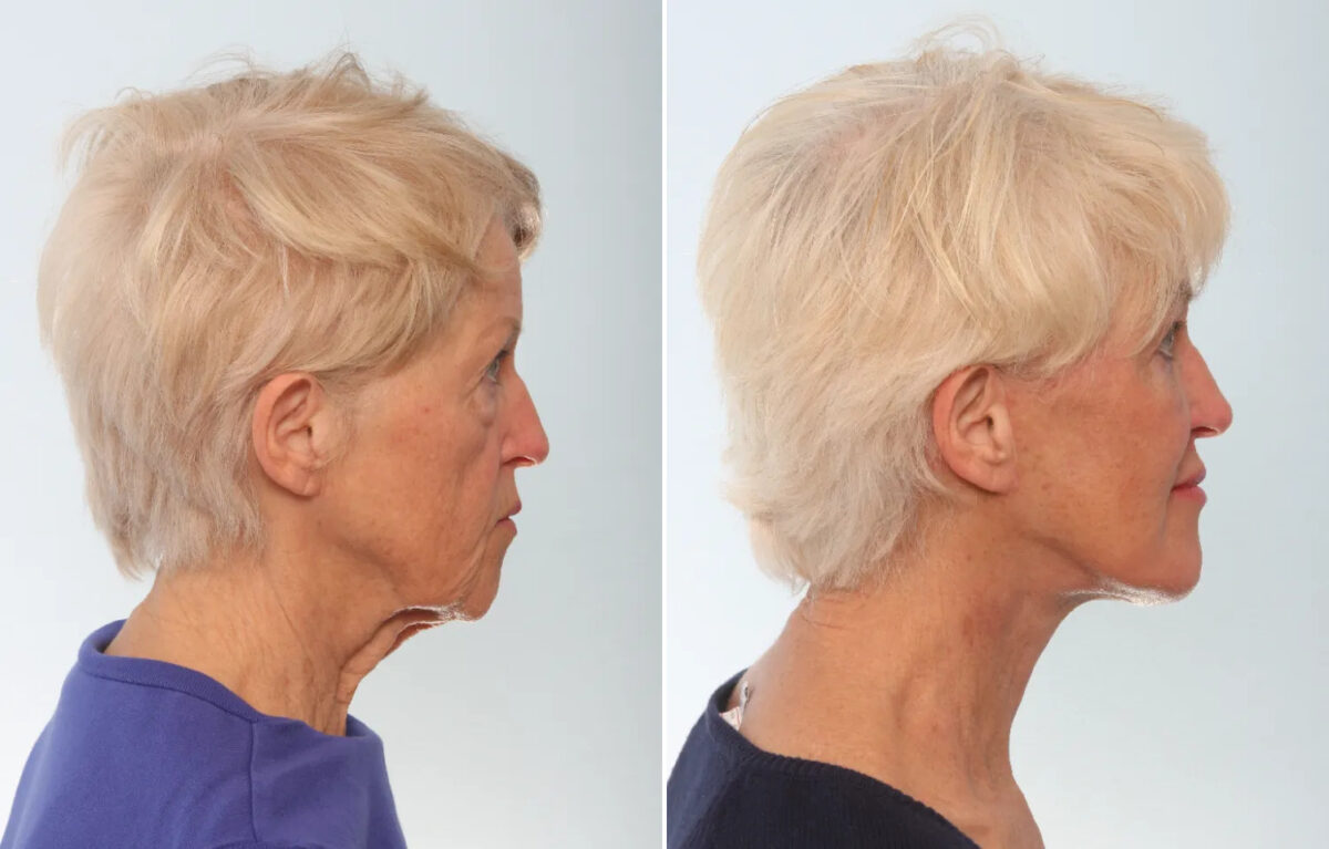 Facelift Before and After Photos in Houston, TX, Patient 87490