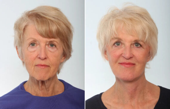 Facelift Before and After Photos in Houston, TX, Patient 87490