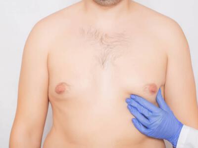 Gynecomastia surgery is a procedure designed to reduce the amount of excess breast tissue in men, giving them a flatter and more contoured chest.