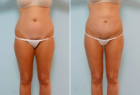 Abdominoplasty Before and After Photos in Houston, TX, Patient 24480