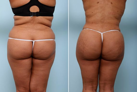 , Before and After Photos