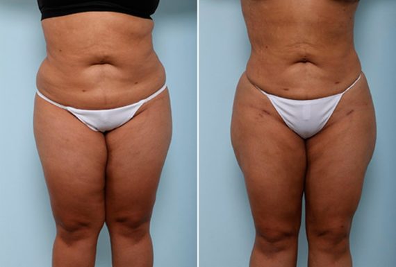 , Before and After Photos