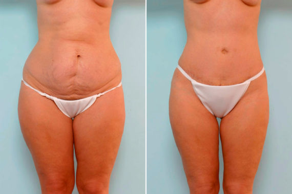, Before and After Photos