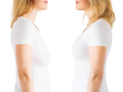 Dr. Vitenas secures a fuller appearance on your breasts and a more confident you after a Breast lift Procedure in Houston, TX