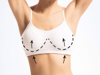 After breast lift surgery, it's important to follow a proper scar care regimen to reduce the visibility of scars and ensure optimal results.