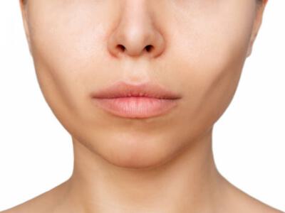 Close-up of a person's lower face post-buccal fat removal, showing enhanced facial definition.