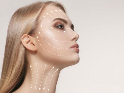 Side profile of a woman with dotted lines marking potential Botox or Xeomin injection sites.